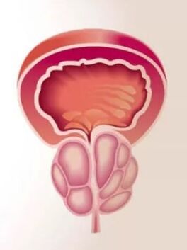 Inflammation of the prostate